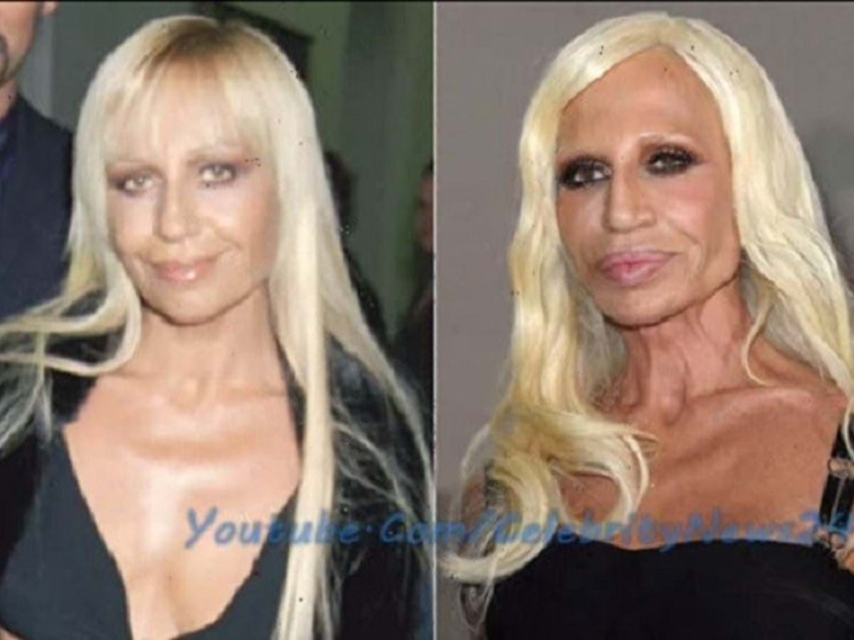 Donatella Versace: antes e depois das cirurgias - FlashVidas - Vidas
